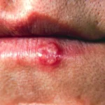 Investigación revela cómo el herpes labial afecta las defensas del cerebro en ratones y su vínculo con el Alzheimer