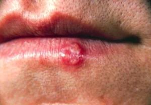 Investigación revela cómo el herpes labial afecta las defensas del cerebro en ratones y su vínculo con el Alzheimer